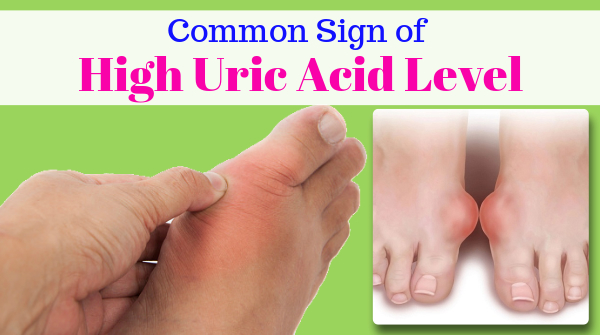 Symptoms of high uric acid