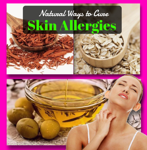 Skin Allergies Home Remedies