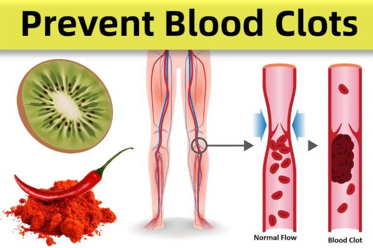 foods that prevent blood clot