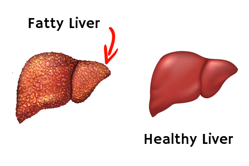 what is fatty liver disease